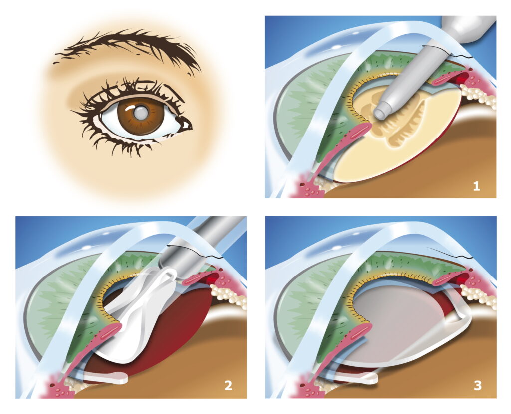 chirurgie cataracte